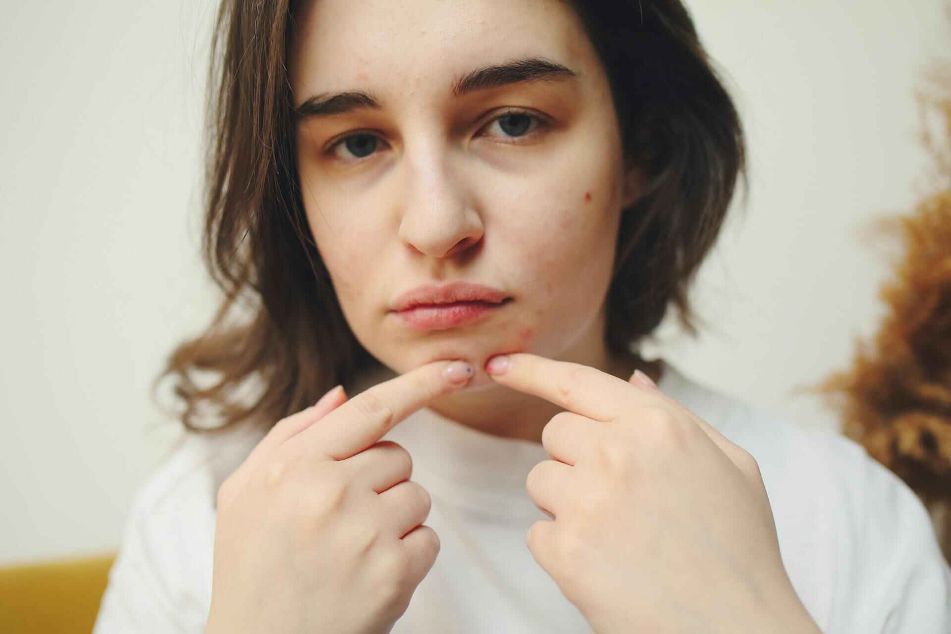 acne; breakouts; how collagen supplements help acne; collagen supplement singapore; anti pimple collagen