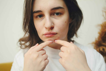 acne; breakouts; how collagen supplements help acne; collagen supplement singapore; anti pimple collagen